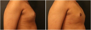 gynecomastia-before-after-and-after-photo-10-3