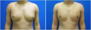 gynecomastia-before-after-and-after-photo-12-1
