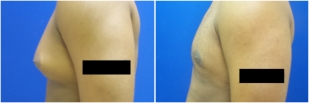 gynecomastia-before-after-and-after-photo-12-2