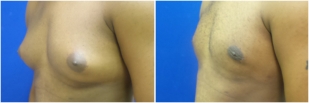 gynecomastia-before-after-and-after-photo-12-3