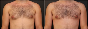 gynecomastia-before-after-and-after-photo-13-1