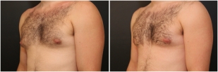 gynecomastia-before-after-and-after-photo-13-2