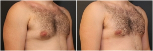 gynecomastia-before-after-and-after-photo-13-3