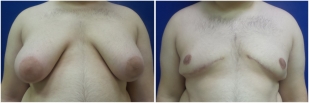gynecomastia-before-after-and-after-photo-14-1
