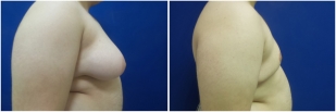gynecomastia-before-after-and-after-photo-14-2