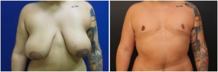 top-surgery-before-after-and-after-photo-10-1
