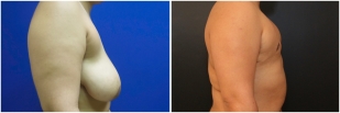 top-surgery-before-after-and-after-photo-10-2